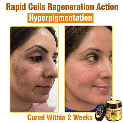 Bee Venom Skin Repair Cream – Anti-Aging & Acne Solution