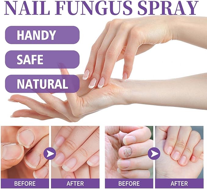 Gentle Nail Fungus Remover Maxum