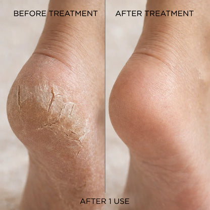 SoftStep Callus Remover