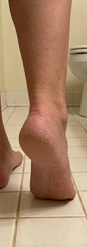 SoftStep Callus Remover